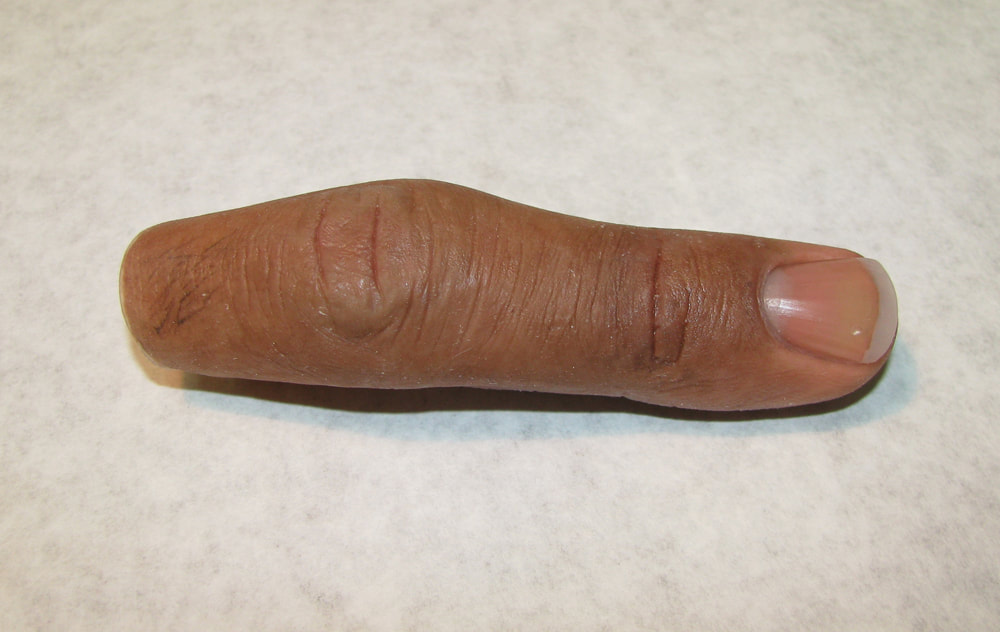 A custom silicone finger prosthesis by Functional Restorations 