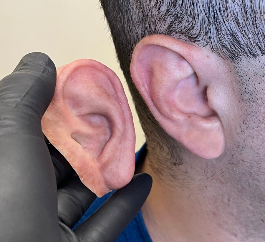 Silicone Auricular Prosthetic Ear