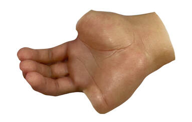 A basic realism custom silicone hand prosthesis by Functional Restorations