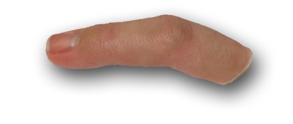 Silicone finger for finger amputation fabricated by David Robinson Functional Restorations in Durham North Carolina