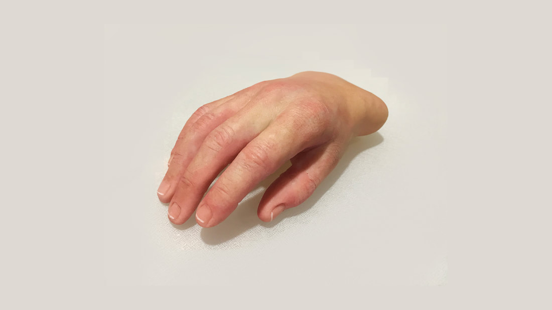 Custom Silicone High Realism Partial Hand Prosthesis by Functional Restorations