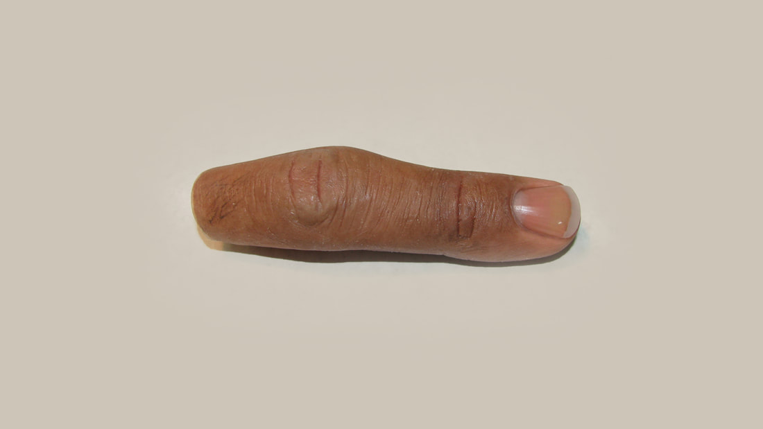 Custom Silicone High Realism Prosthetic Finger by Functional Restorations
